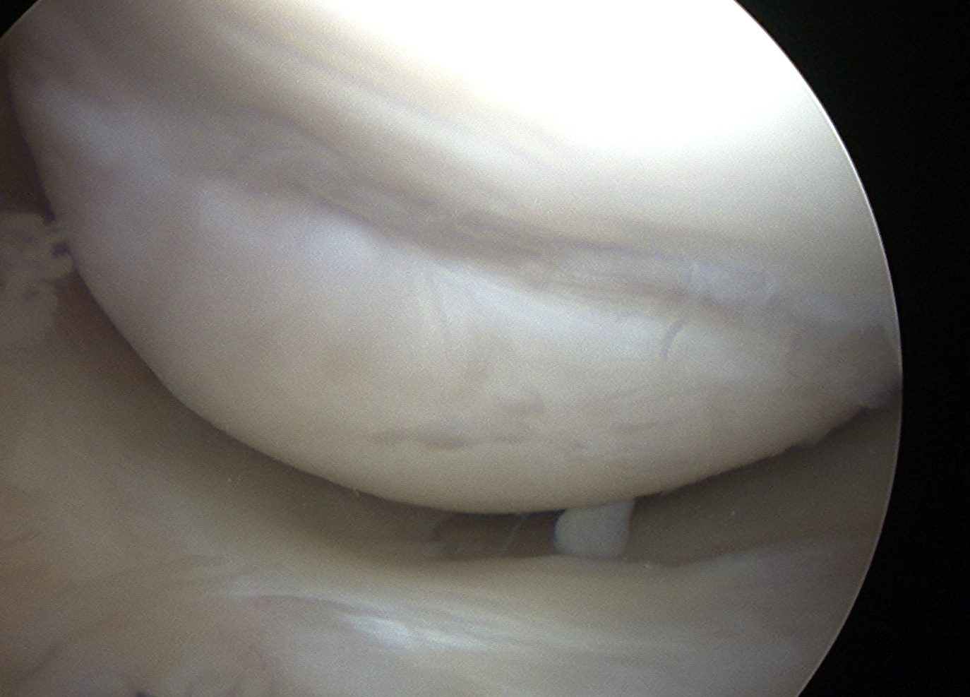 Lateral Femoral Condyle Impaction Post ACL Injury